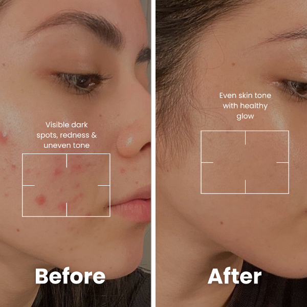 Why choose Acne Care face wash